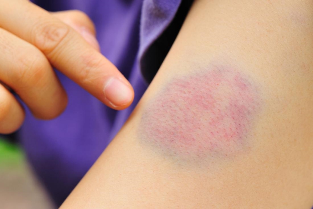 how do you get rid of a bruise in 24 hours how do you get rid of a bruise in 24 hours