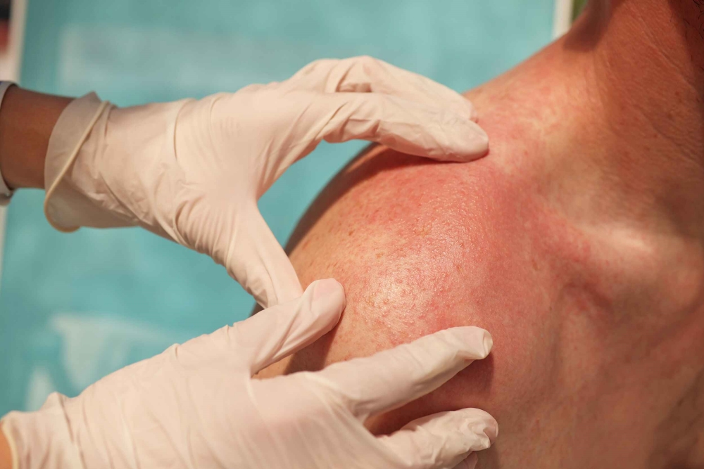 how to get rid of heat rash quickly