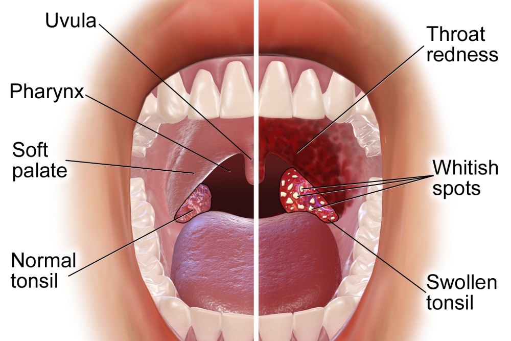 white spots on tonsils