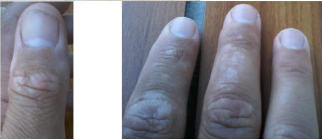 Effective Nail Psoriasis Treatment: Options and Recommendations