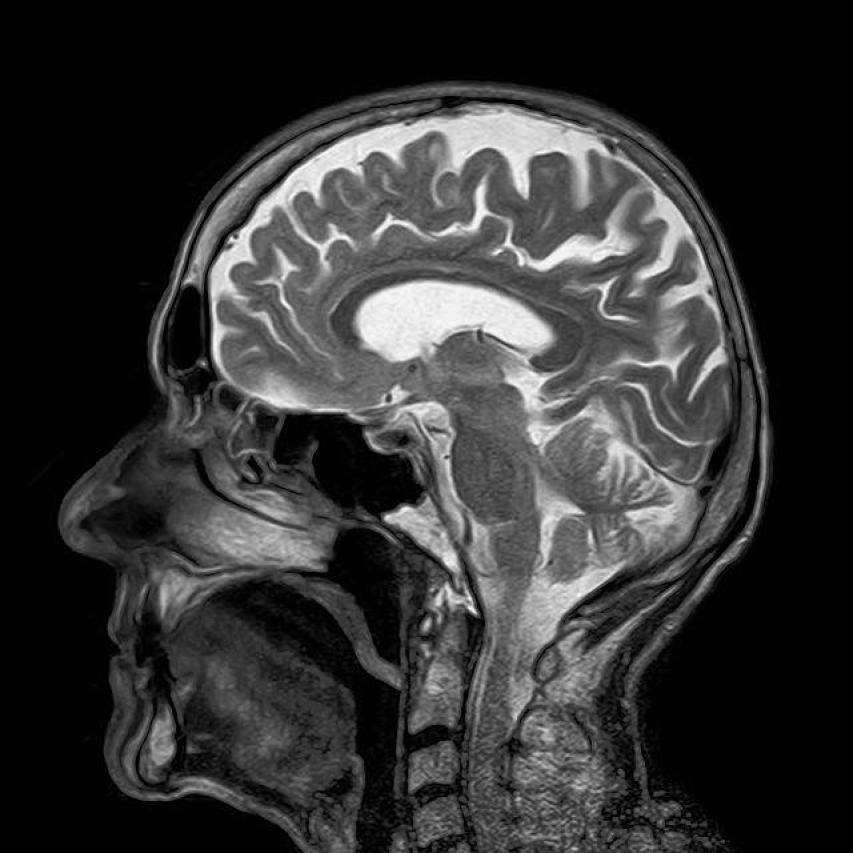 Unlocking Your Mind: The Cost of a Brain MRI
