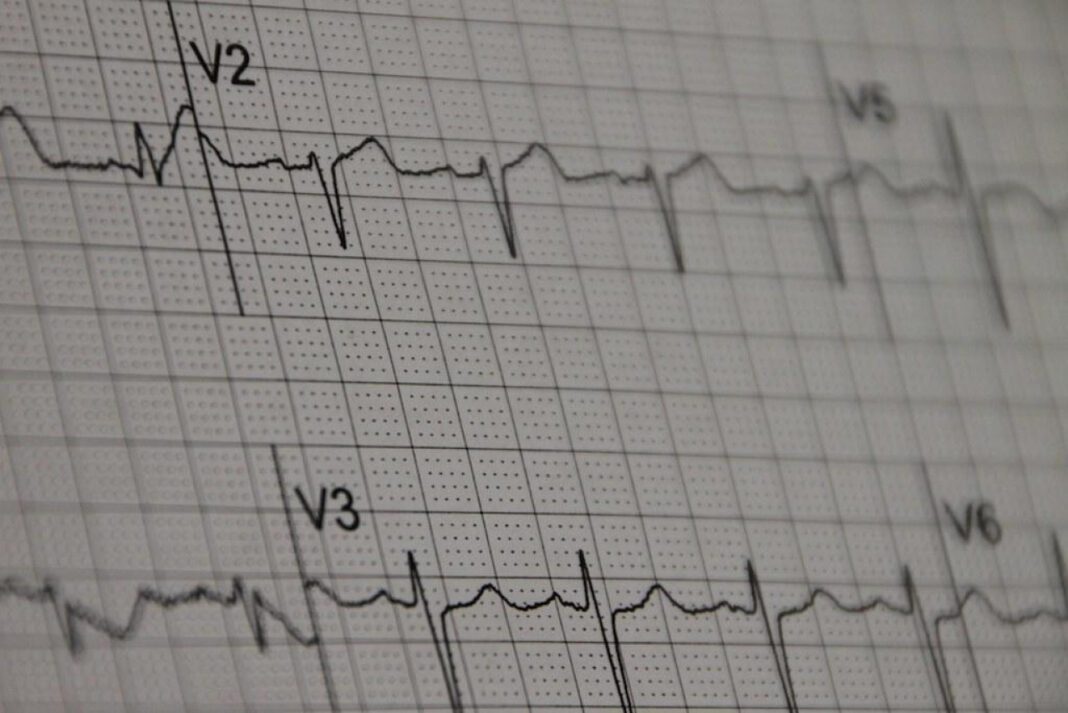 Unveiling the True Price of EKG Tests: A Guide