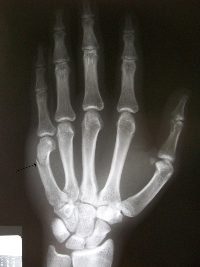 Mend it Right: Avoiding a Boxer’s Fracture Gone Awry