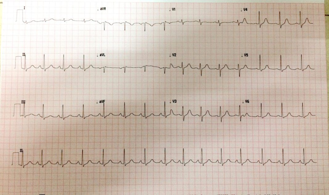 Affordable EKG Prices: Heart Health on a Budget