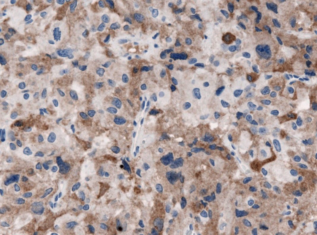 Low TSH, Normal T4 and T3: What It Means