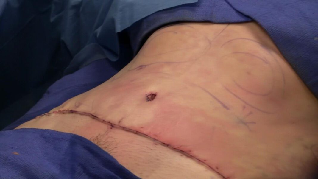 Survivors of Skin Removal: A Harrowing Story