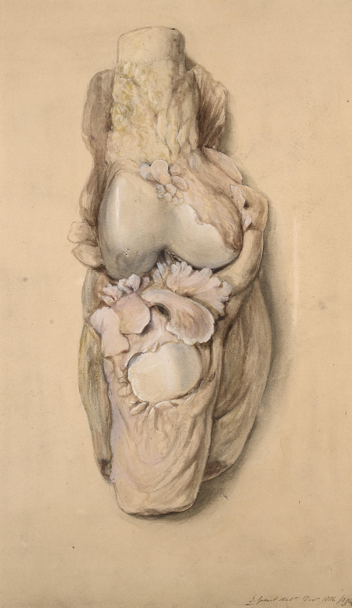 Understanding Synovitis: Causes, Symptoms, and Treatment