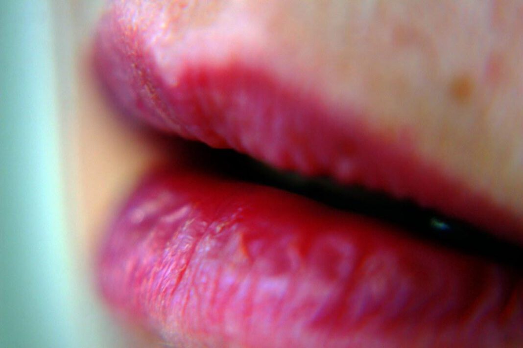 Lip Bump, not Cold Sore: Causes and Treatment